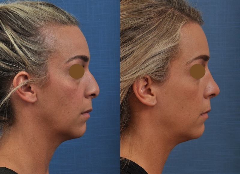 plastic surgery trends