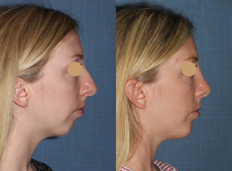 plastic surgery trends