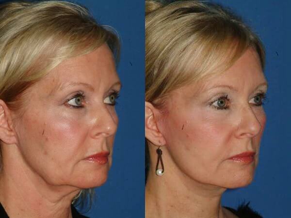 plastic surgery trends