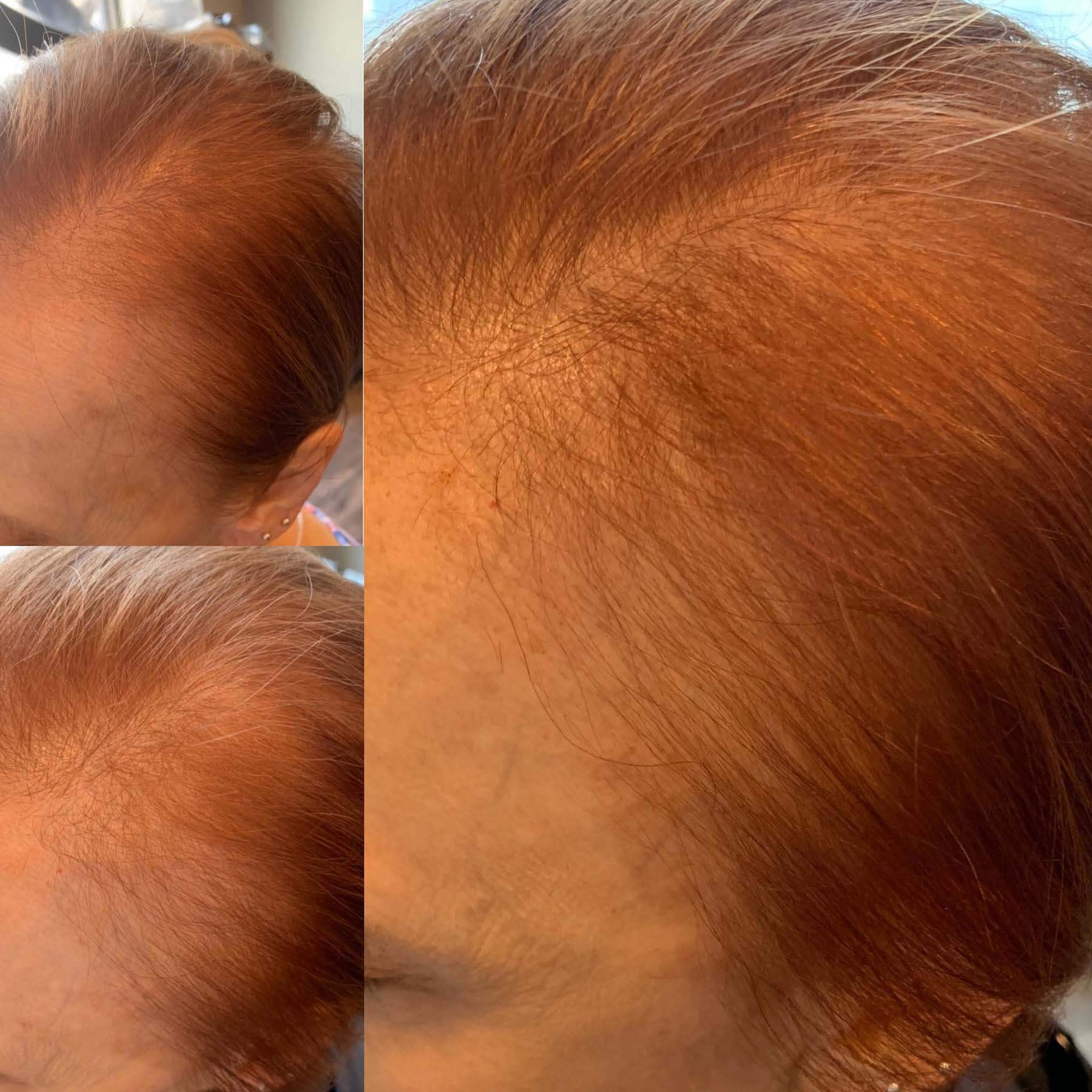 Susanne uses Zenagen on her own clients, seeing dramatic results after 12 weeks. Top left photo: before Zenagen, bottom left photo: 8-week progress, right photo: 12-week progress. Image: Susanne Post Before and after results of Zenagen, a hair loss product
