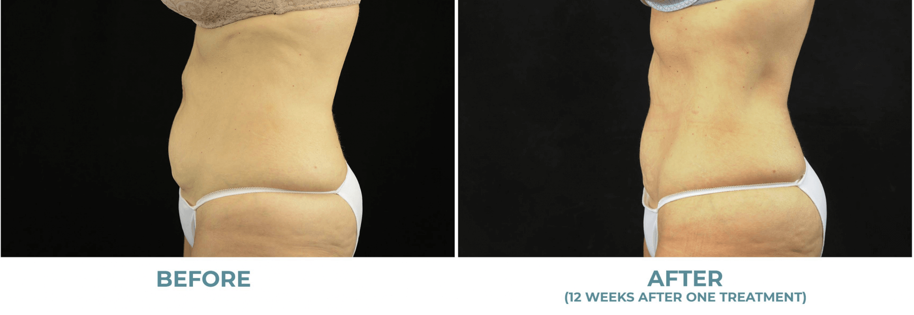 Woman's abdomen before and after EON treatment