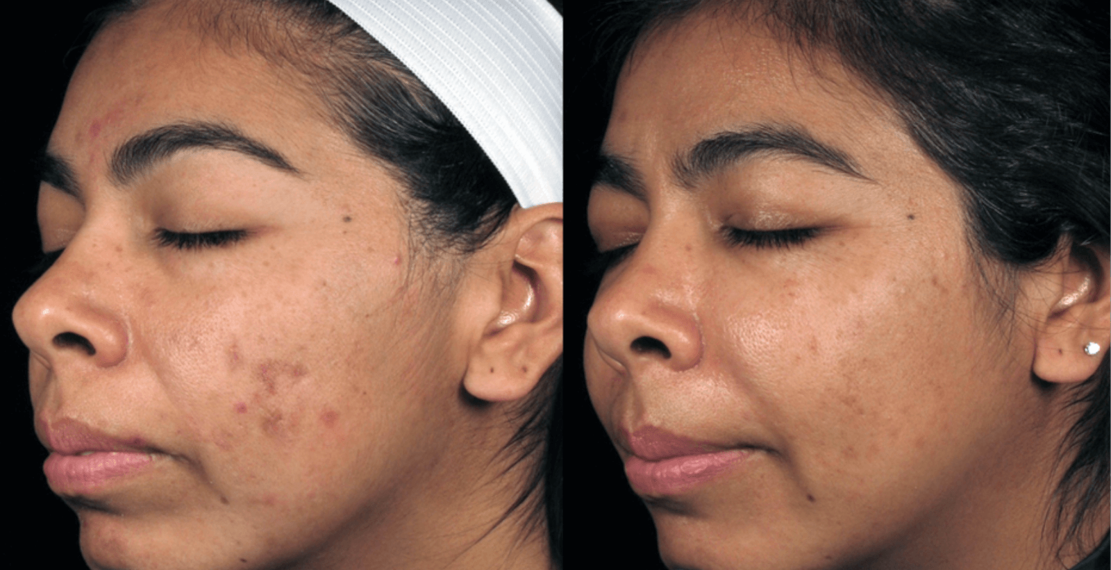 Before and after photos showing the benefits of the DiamondGlow™ Facial