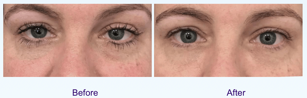 Before and after photos showing the benefits of under-eye fillers