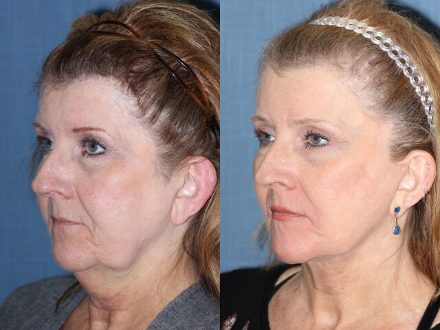 Before and after images showing the results of a deep plane facelift