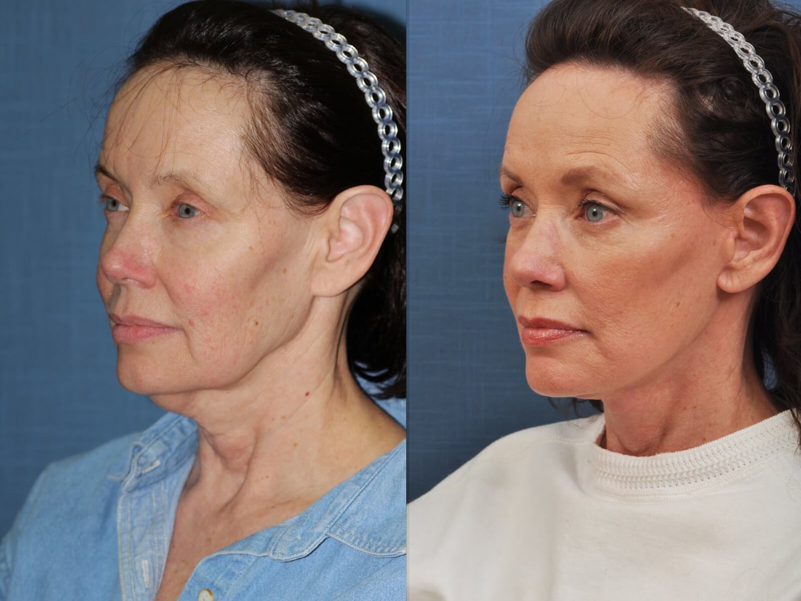 Before and after images of facelift