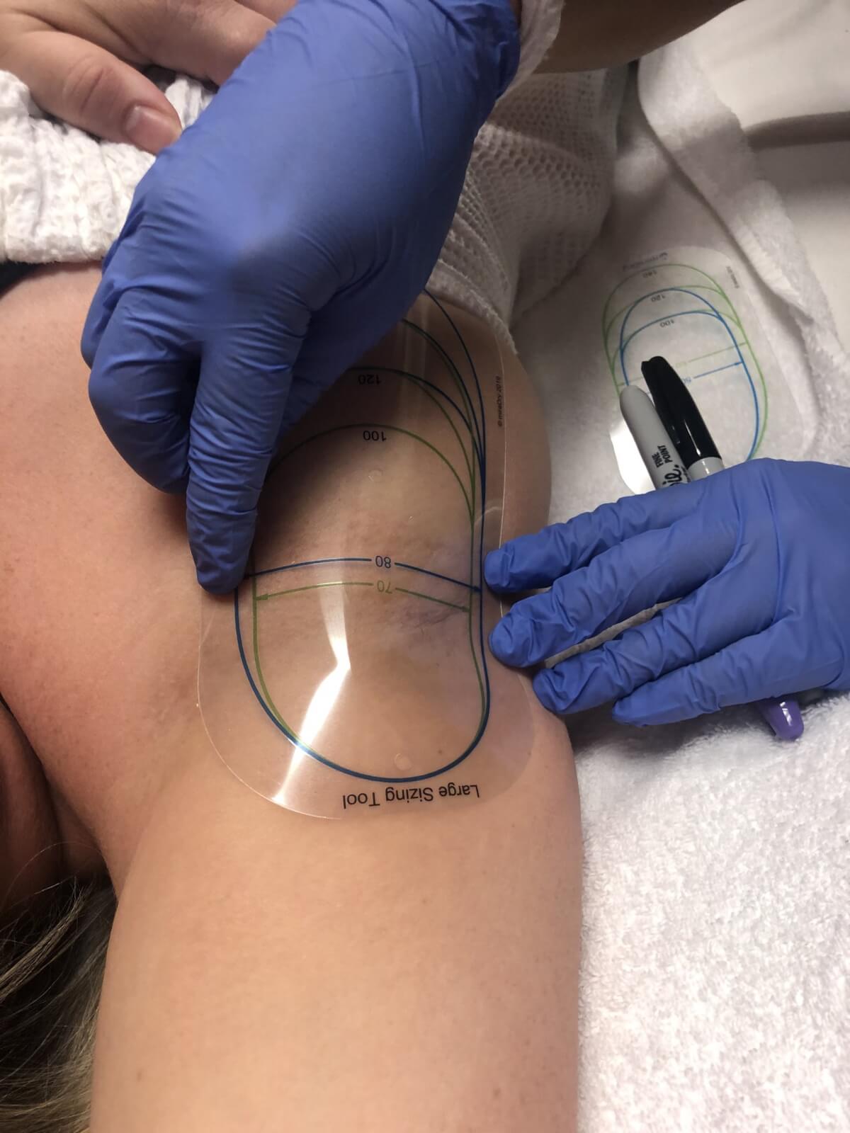 Medical professional drawing temporary tattoo on patient's underarm area.