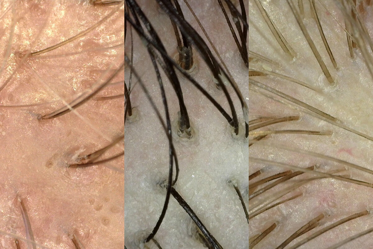 Close-up images of human scalp hair provided by hpihair partners reveal different conditions, including dry, oily, and normal hair. The detailed shots highlight visible hair follicles and varying levels of hair health.