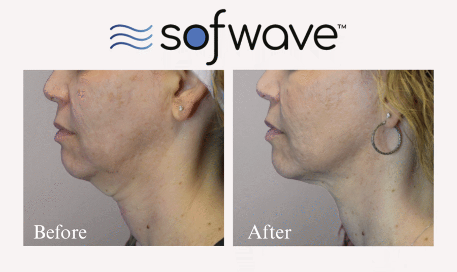 Nashville Steals, Deals & Announcements: March 2026 - 8 Side-by-side comparison of a woman's lower face and neck before and after Sofwave treatment, featured in Nashville Deals, highlights reduced sagging and visibly improved skin tightness.