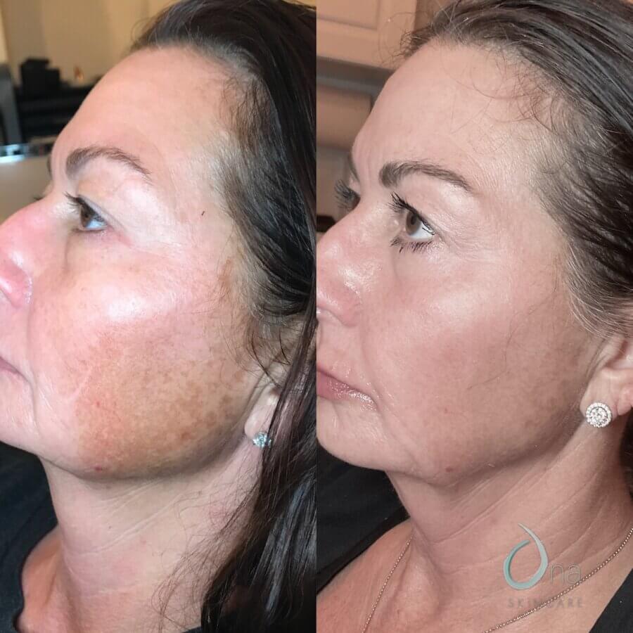 Nashville Steals, Deals & Announcements: March 2026 - 2 Side-by-side comparison of a woman's face before and after skincare treatment, showing reduced dark spots and more even skin tone on the right—perfect for those seeking Nashville deals this March 2026.