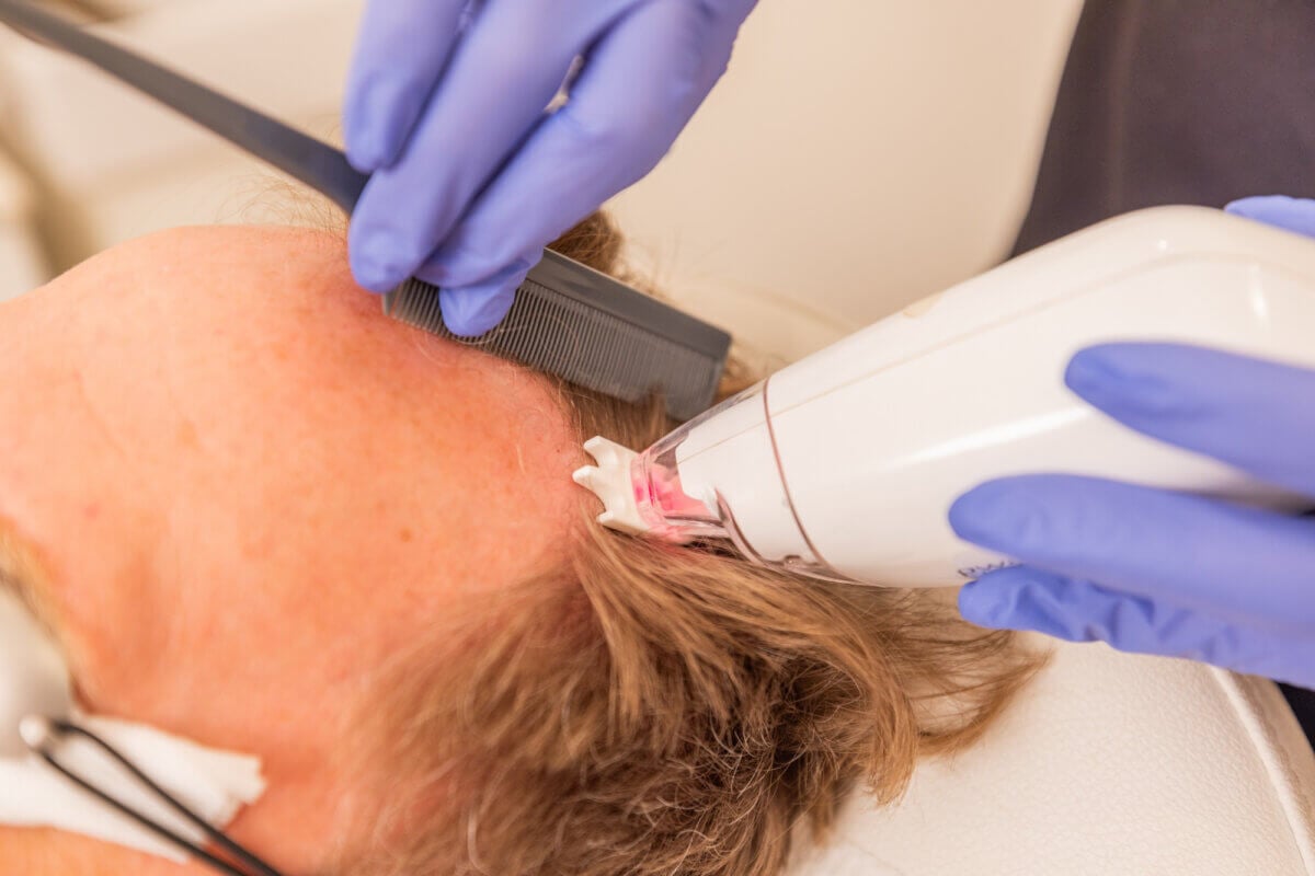 Nashville Steals, Deals & Announcements: June 2026 - 3 A person wearing protective eyewear receives a hair removal treatment on the hairline with a handheld laser device, operated by someone in blue gloves.