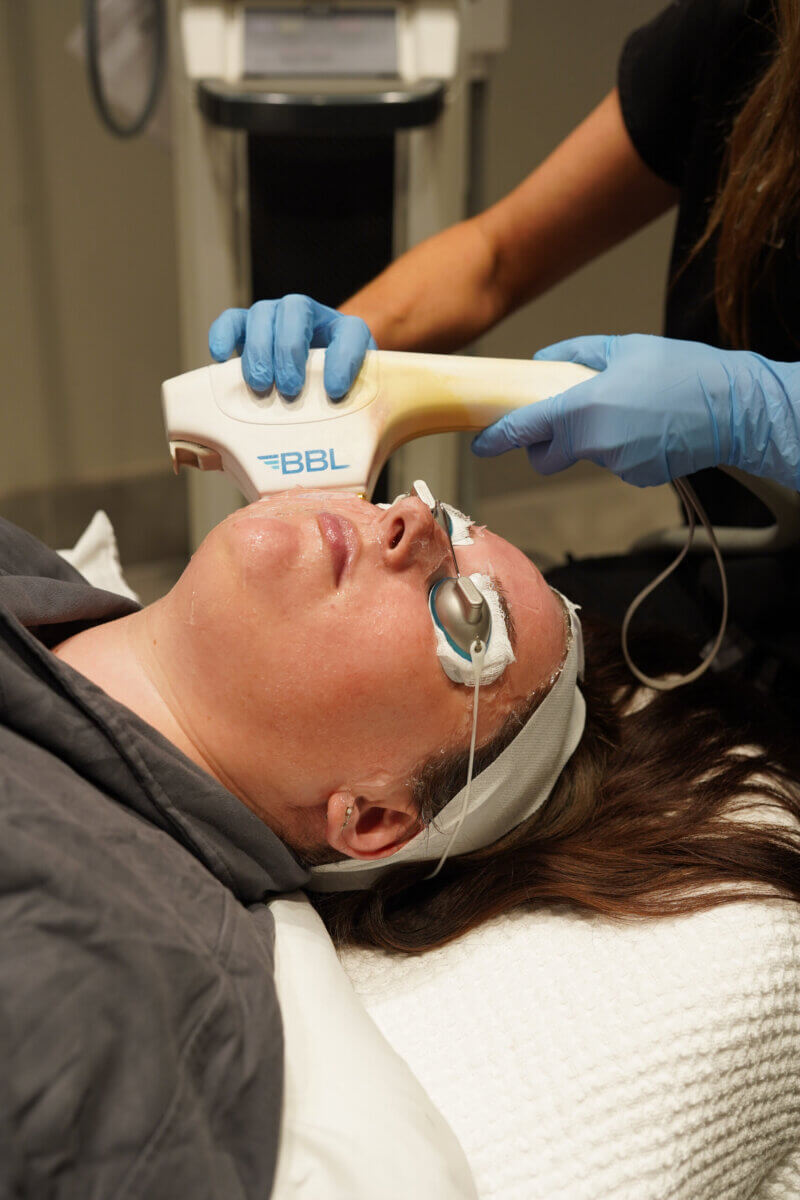 Yes, You Can Get Laser Treatments in Summer! Here's What to Know. - 6 A person receives a BBL (BroadBand Light) facial treatment from a gloved technician while lying on a clinic bed, wearing protective eye covers.