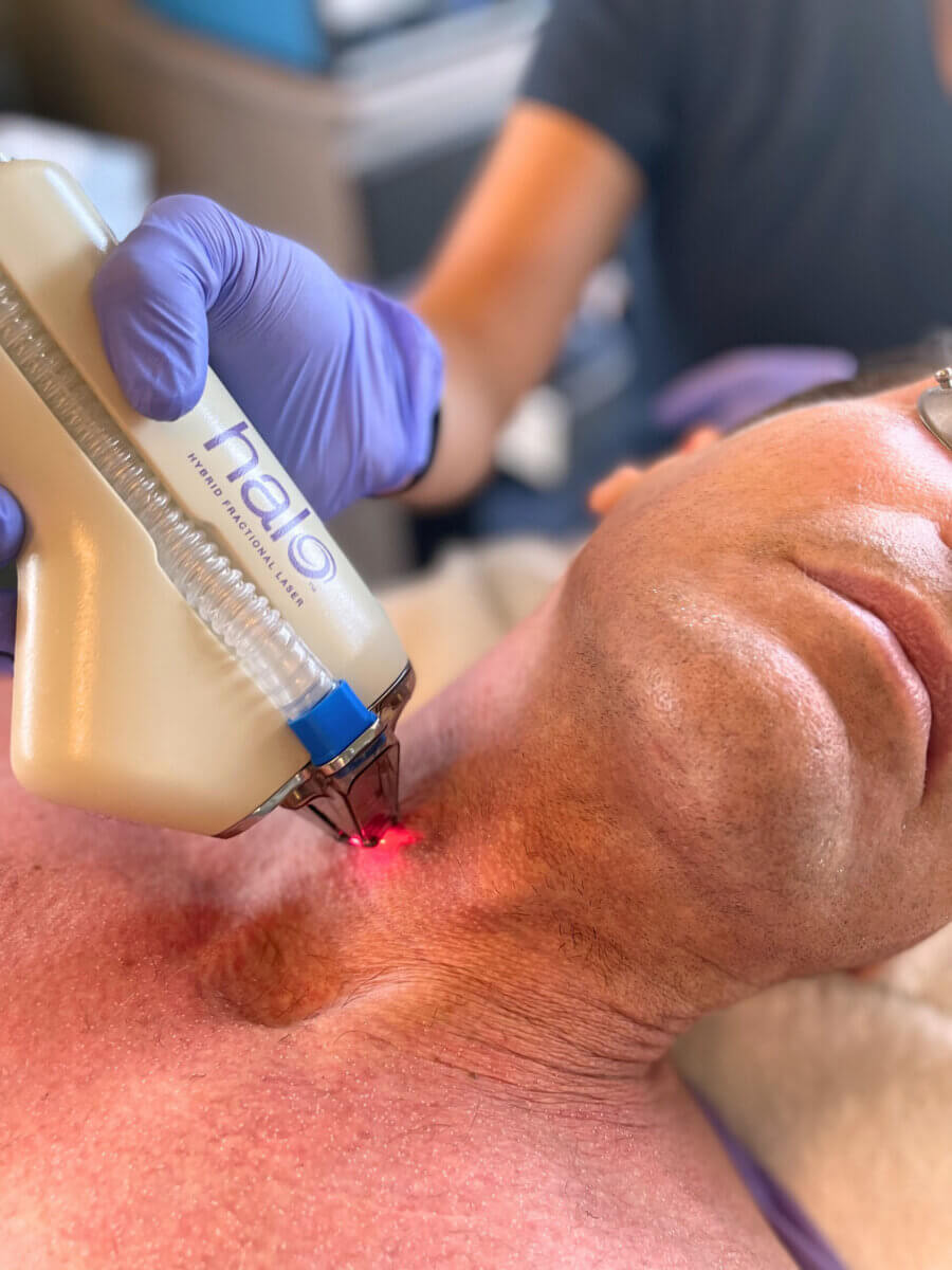 Yes, You Can Get Laser Treatments in Summer! Here's What to Know. - 4 A person receives a Halo laser skin treatment on the neck area from a practitioner wearing purple gloves.