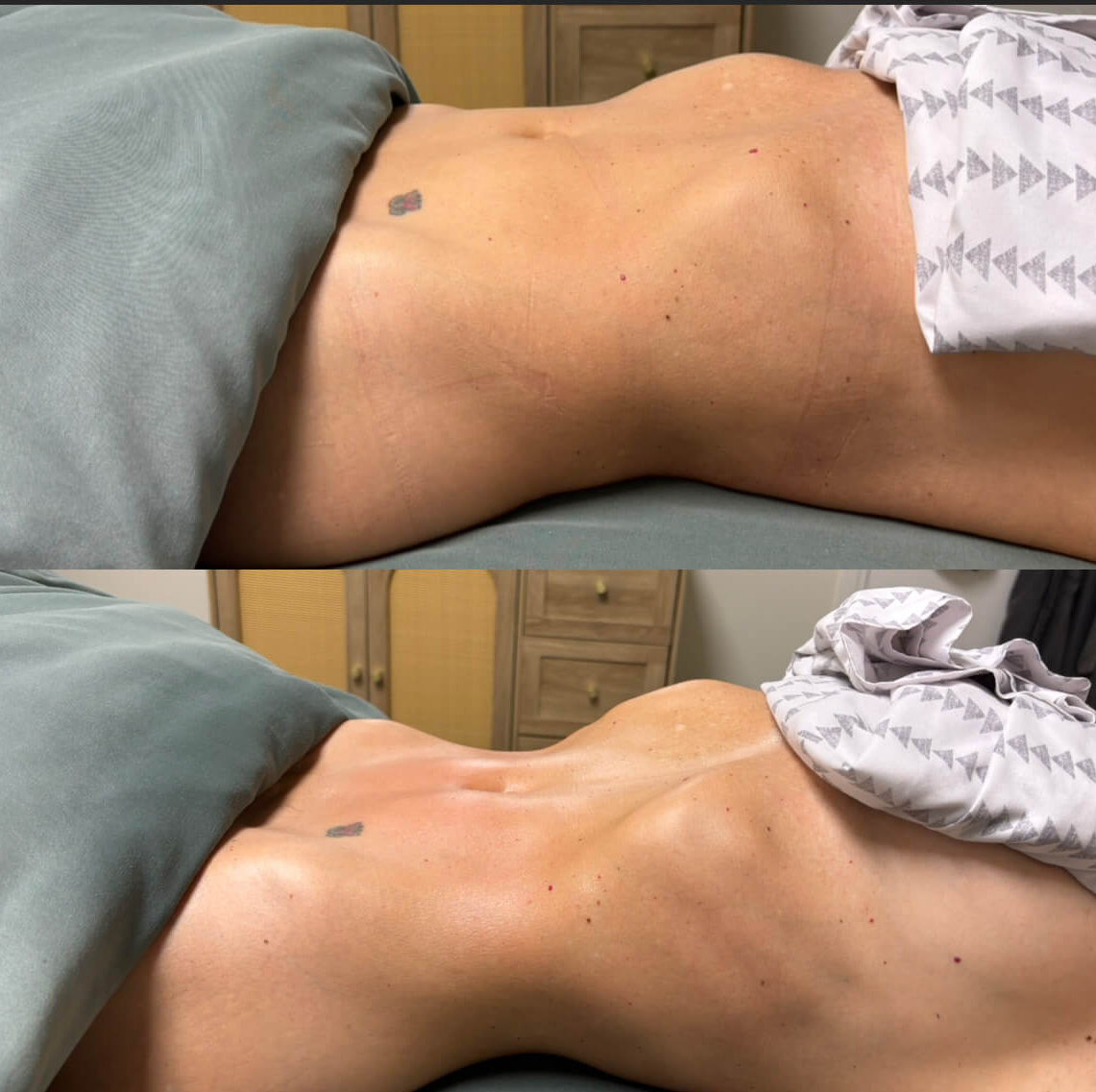 Two side-by-side photos of a person’s torso lying on a massage table highlight the impressive before and after results following a lymphatic drainage session, with visible differences in muscle definition.