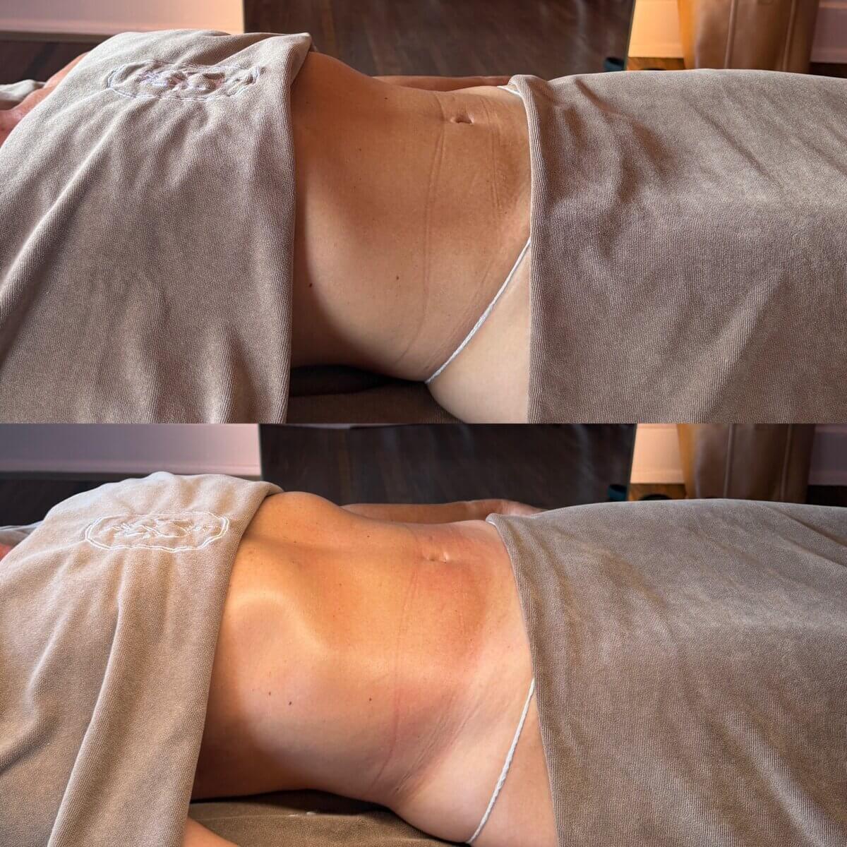 Two side-by-side images show a person lying down under a towel, focusing on their abdomen before and after a lymphatic drainage treatment.