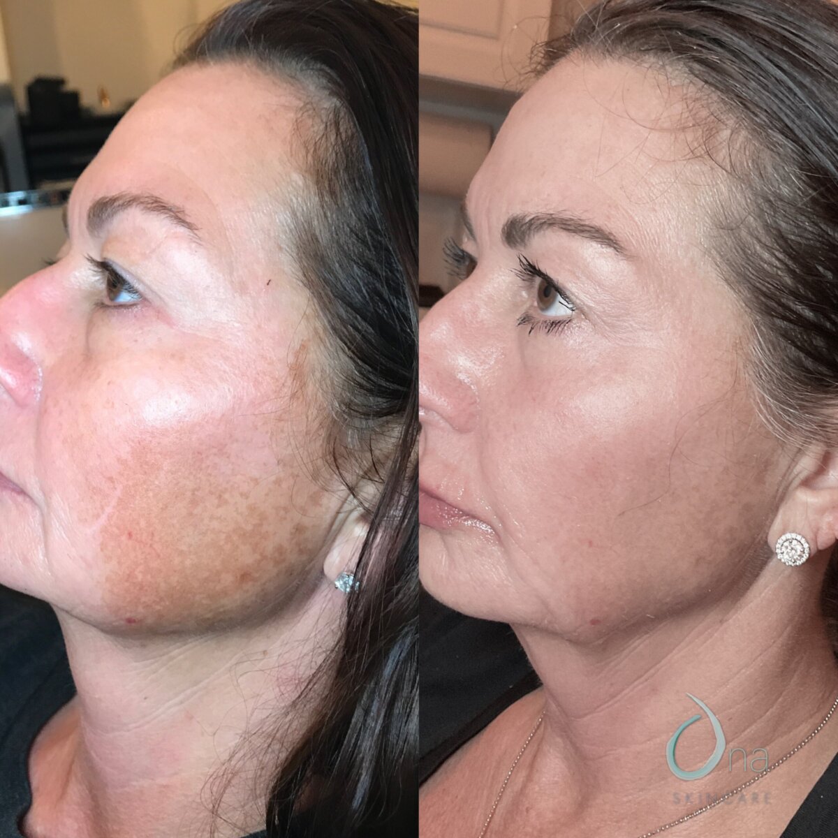 Nashville Steals, Deals & Announcements: October 2026 - 6 Side-by-side comparison of a woman’s face before and after skin treatment, showing reduced pigmentation and smoother skin texture—just one of the impressive transformations you might discover through Nashville Deals this October 2026.